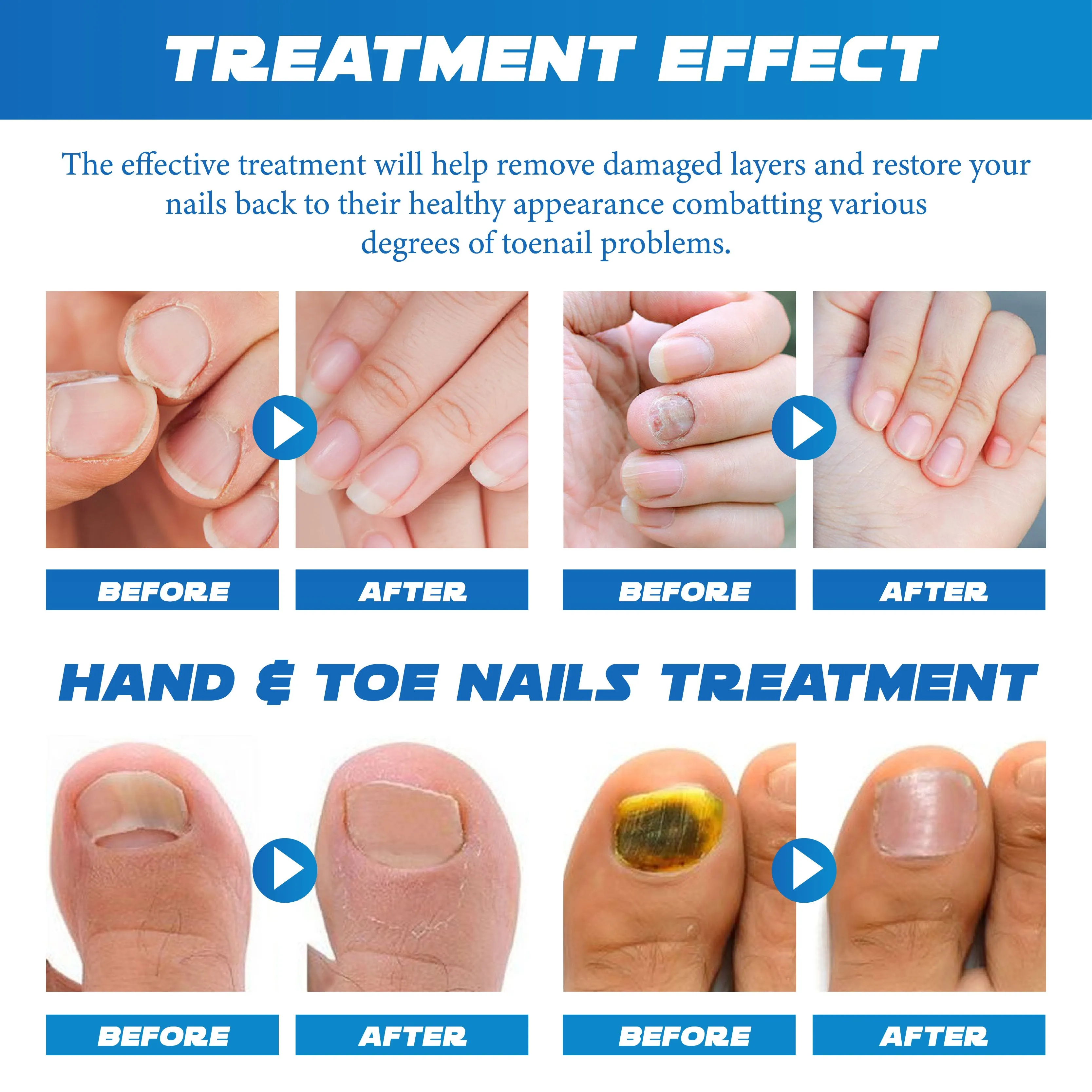 RICPIND LightTherapy NailRenew ProDevice