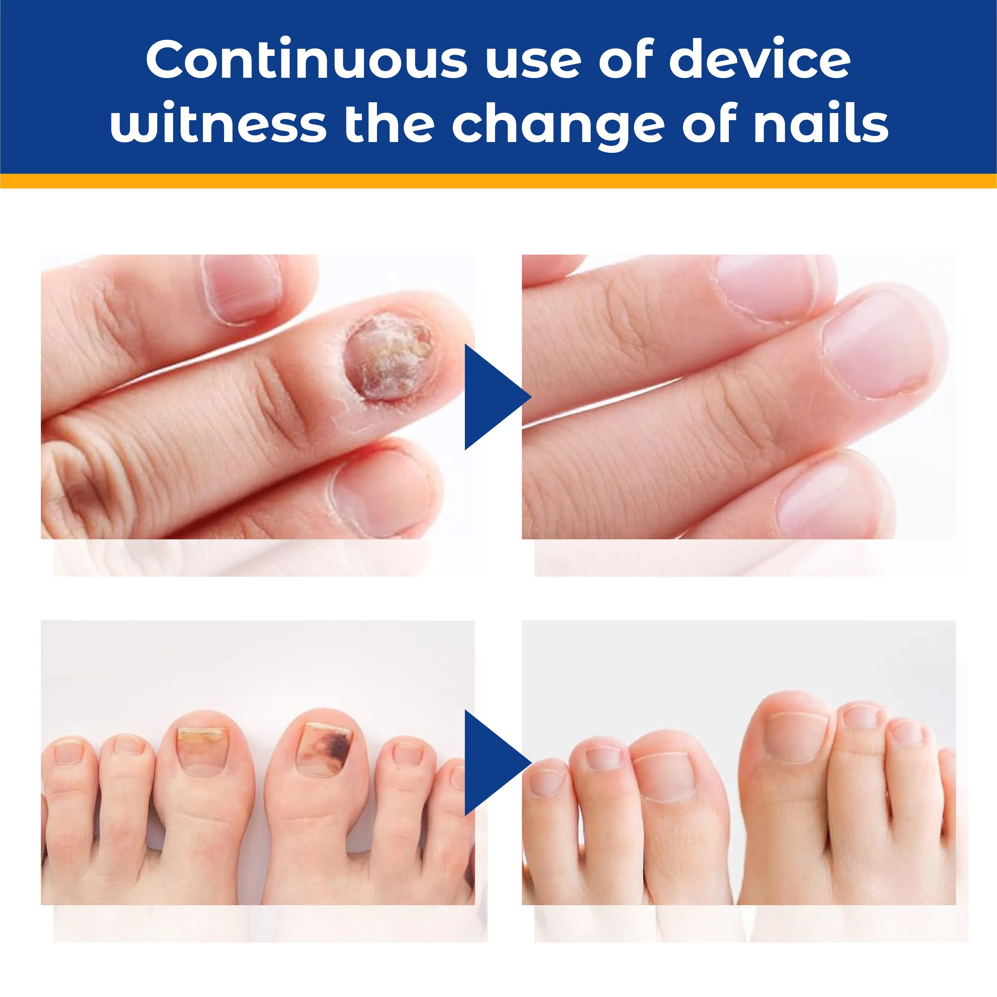 RICPIND Sun Light NailTherapy Device